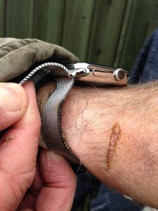 Apple Watch brændte min arm 5